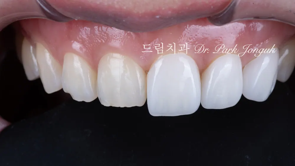 무삭제 라미네이트