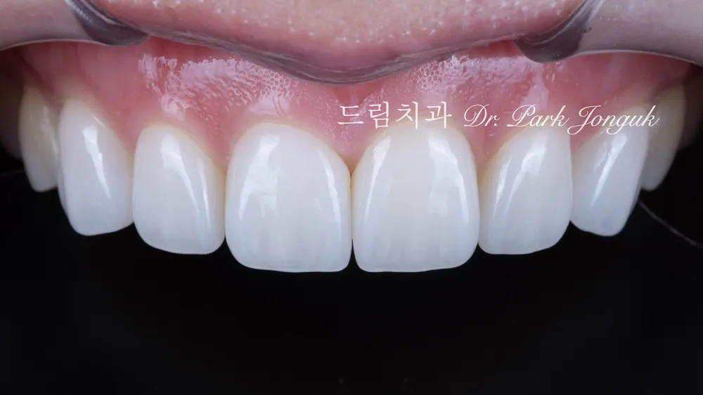 무삭제 라미네이트