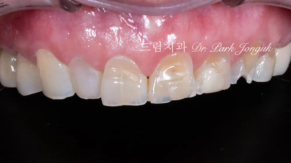50대 60대 노화 라미네이트