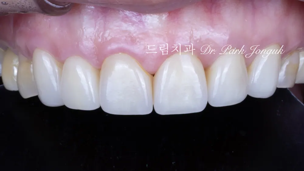 50대 60대 노화 라미네이트