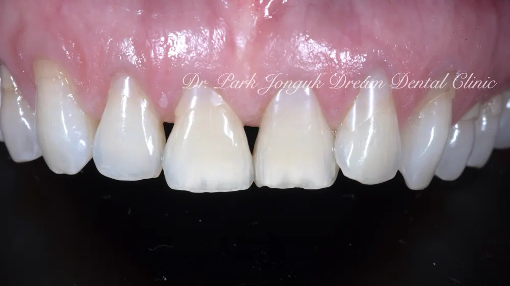 50대 60대 노화 라미네이트