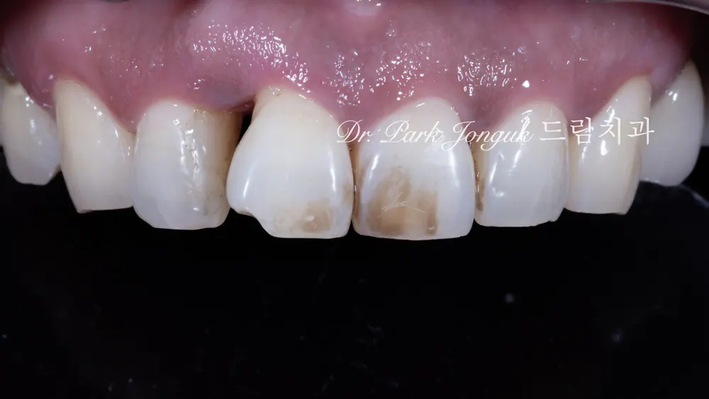 Răng cửa tụt nướu, dán sứ Veneer hồng