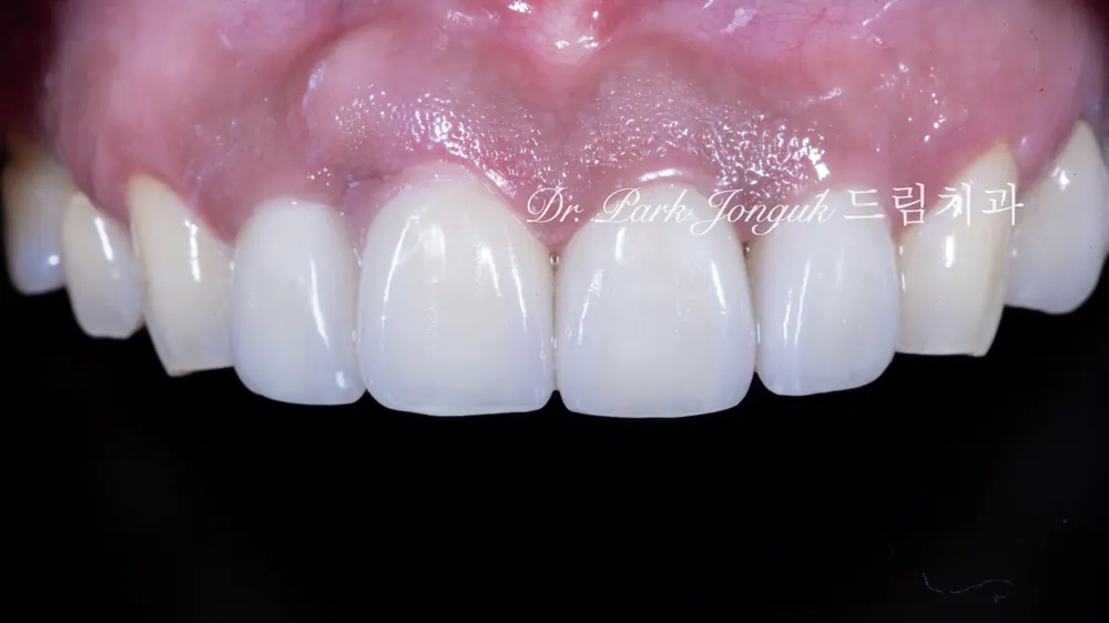 Răng cửa tụt nướu, dán sứ Veneer hồng