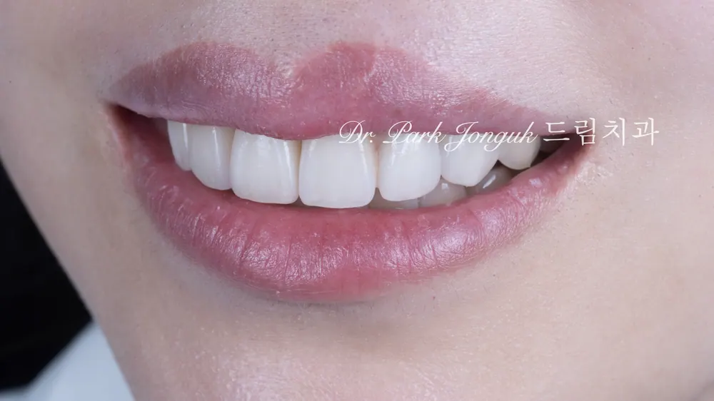 Răng cửa tụt nướu, dán sứ Veneer hồng