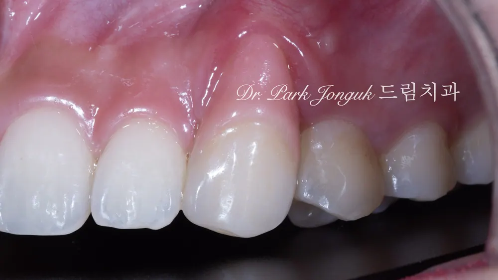 Răng cửa tụt nướu, dán sứ Veneer hồng