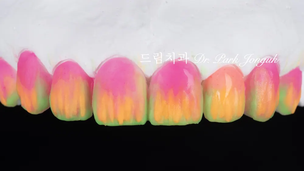 透明且細節鮮活的自然陶瓷貼片