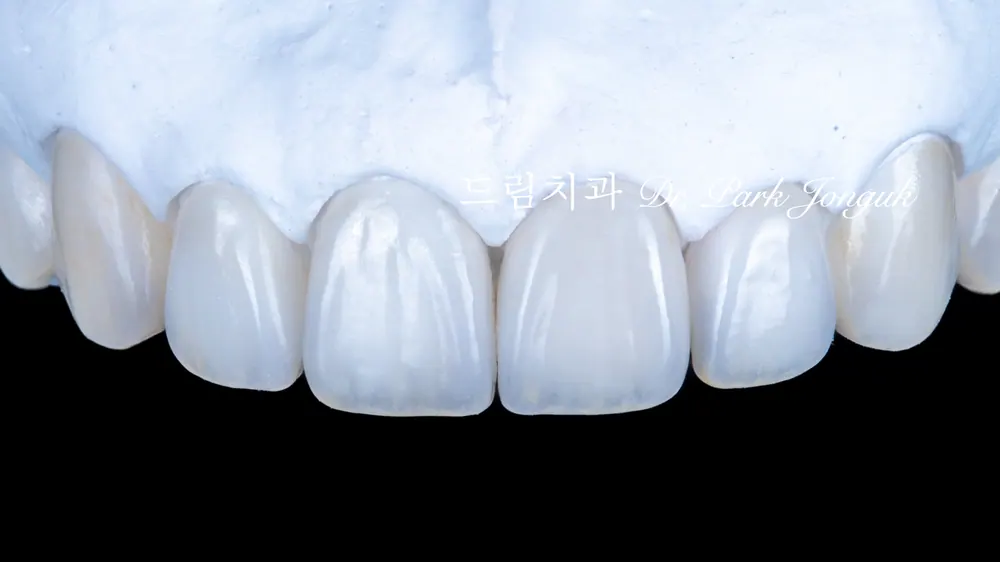 透明且細節鮮活的自然陶瓷貼片