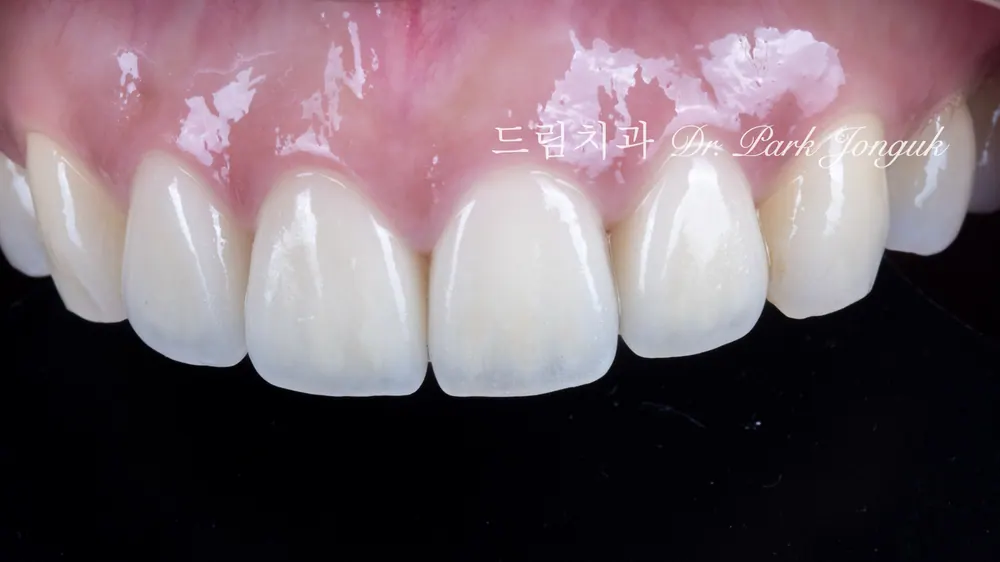 瓷贴面·全瓷冠重新治疗 激光去除