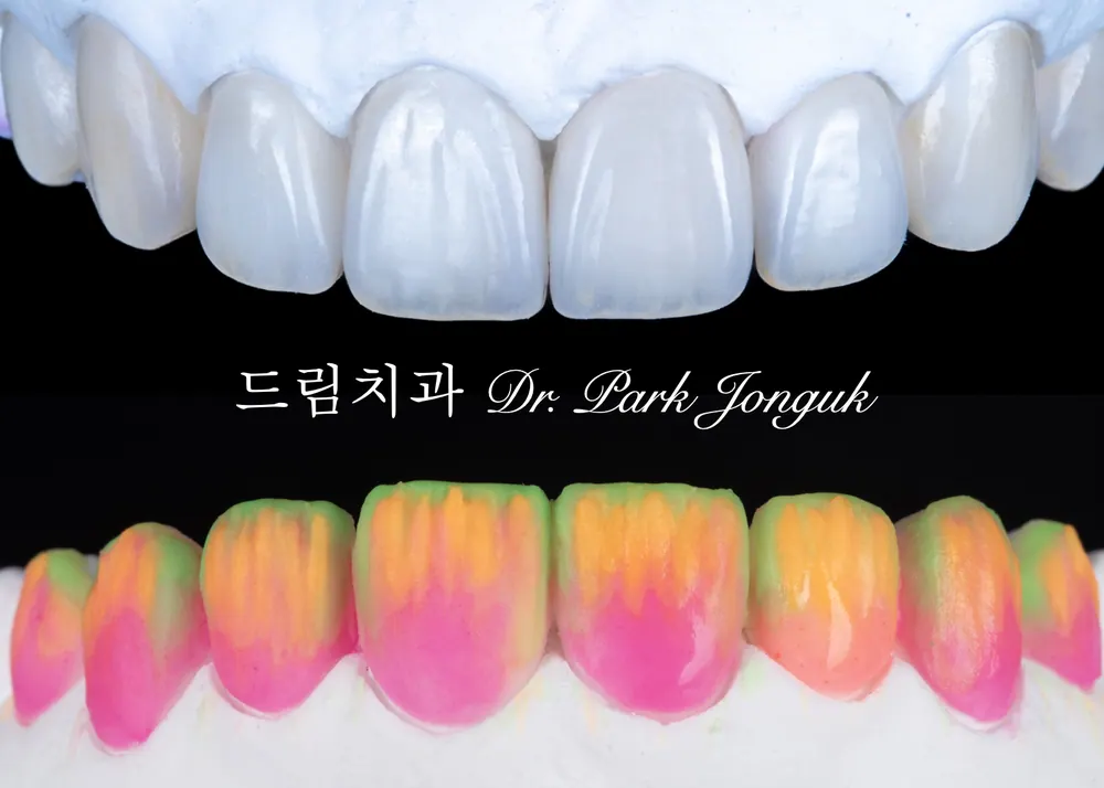 빌드업을 통한 라미네이트의 제작