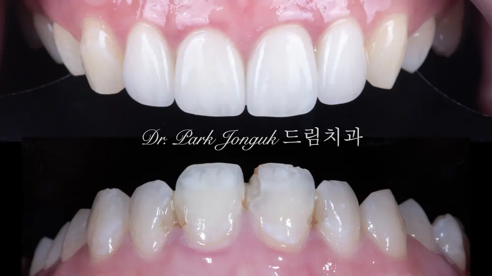 자연치아 같이 만들어지는 라미네이트