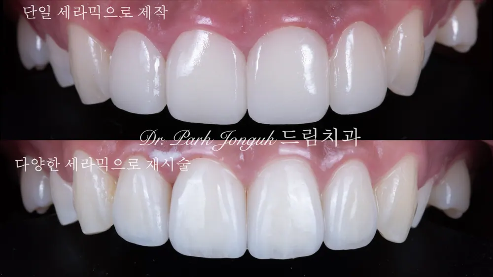투명감 있는 라미네이트로 재시술