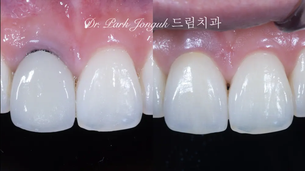 하나의 크라운을 해도 자연치아와 어울리게