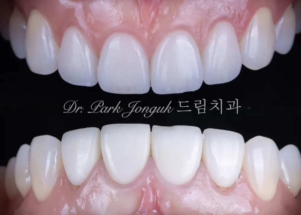 A case where opaque, unnatural-looking veneers were retreated to restore a natural translucency