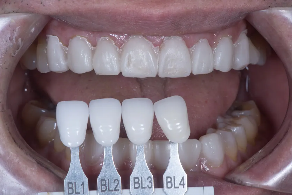 Quá trình xác nhận màu răng bằng cách sử dụng răng tạm