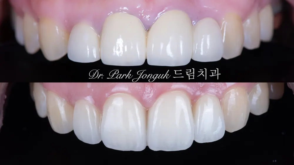 Tái điều trị răng cửa không tự nhiên