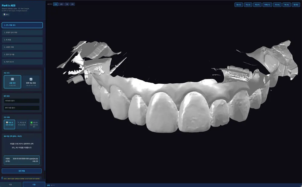 Chương trình chẩn đoán Veneer riêng của Nha khoa Dream, đang trong quá trình đăng ký bằng sáng chế