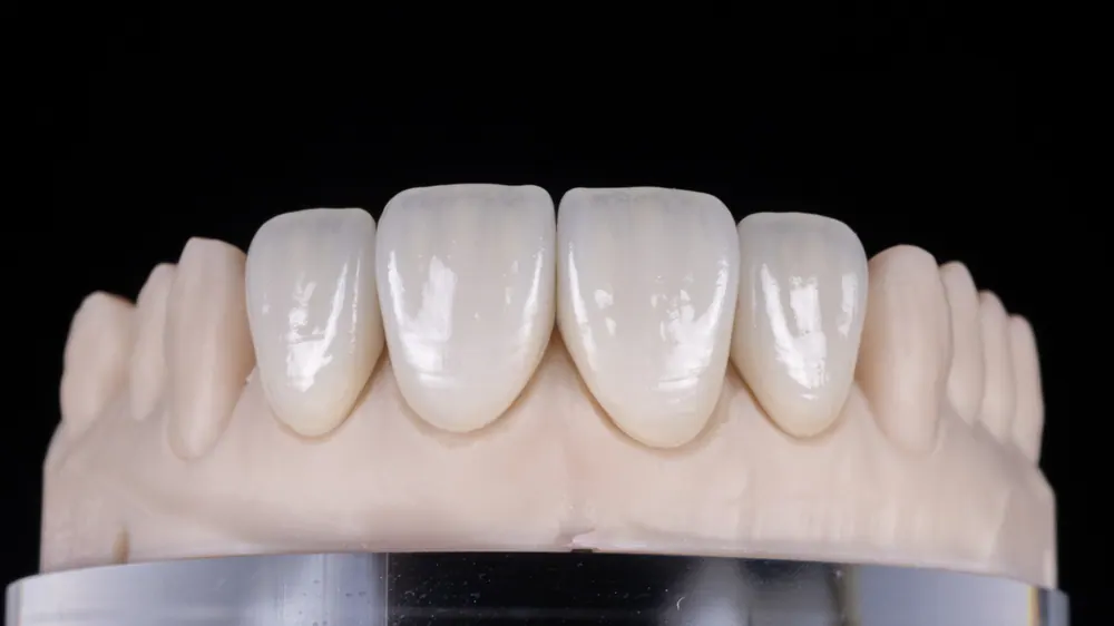 Laminate veneers that preserve the characteristics of natural teeth