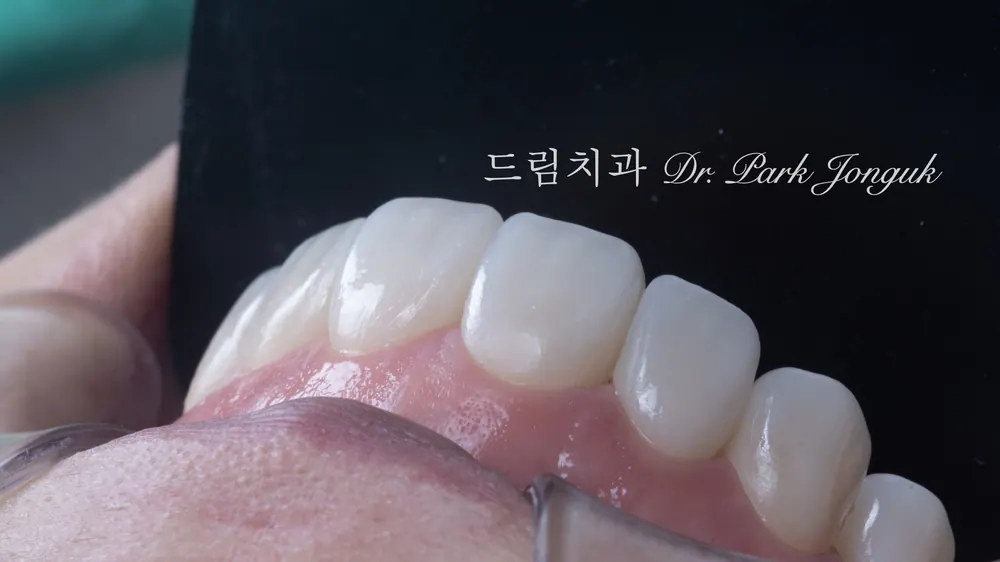 No-prep laminate veneers. Natural and attractive, with good harmony between the veneers and gums.