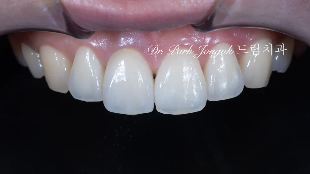 Even when treating only one tooth, it is important to make it blend well with the other teeth