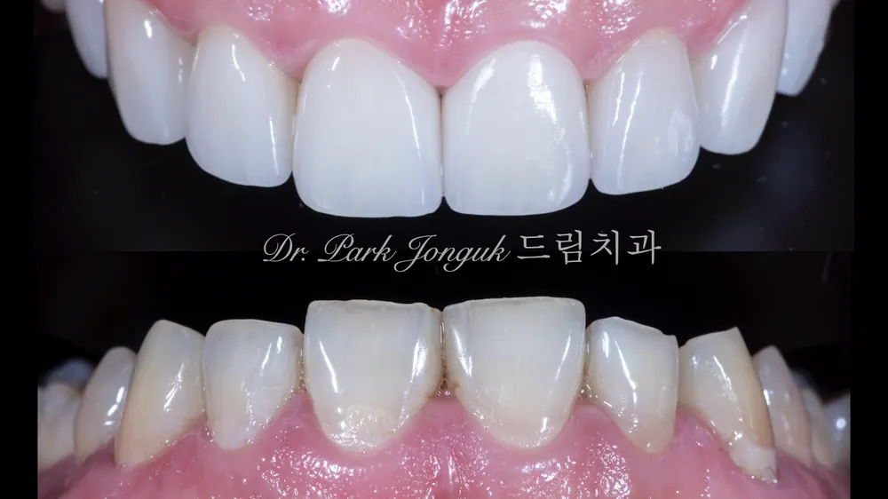 이갈이, 마모등의 문제가 있다면 그 원인을 파악하고 치료하는 것이 중요합니다.