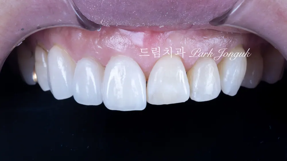 能清晰看出与原牙齿变化对比的不磨牙瓷贴面粘接过程
