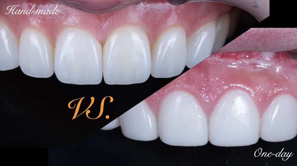 Natural veneers versus artificial-looking veneers