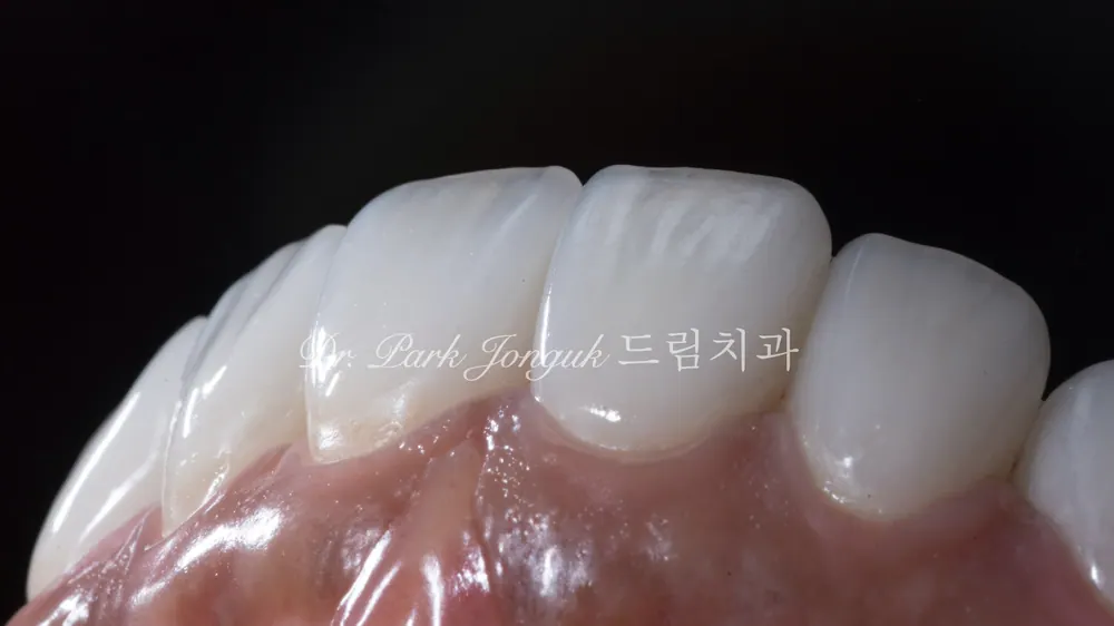 A veneer that harmonizes well with the gum line