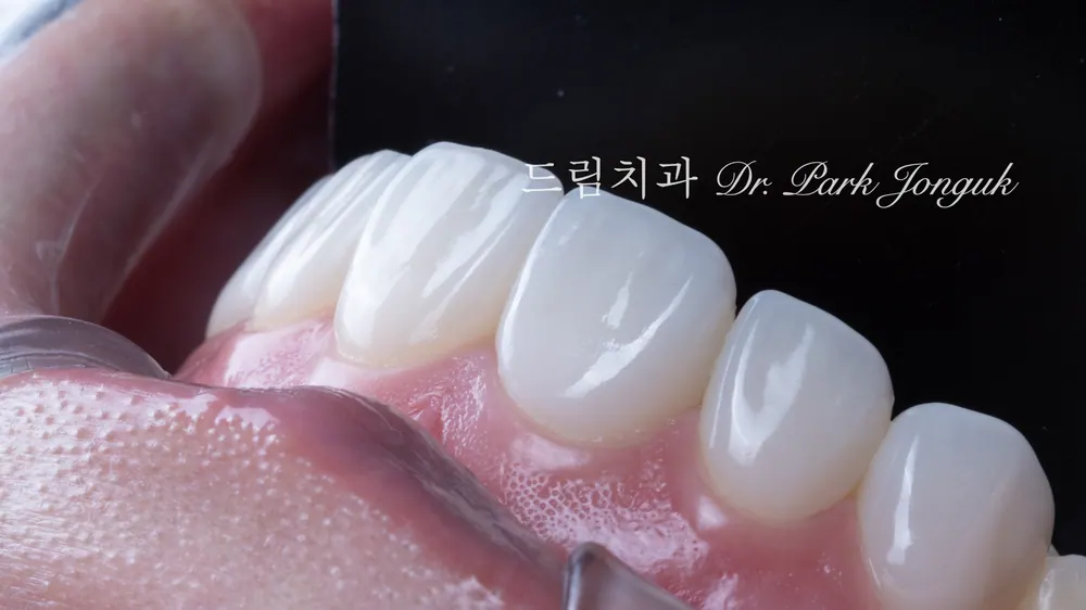 A veneer with even the natural shape fully expressed