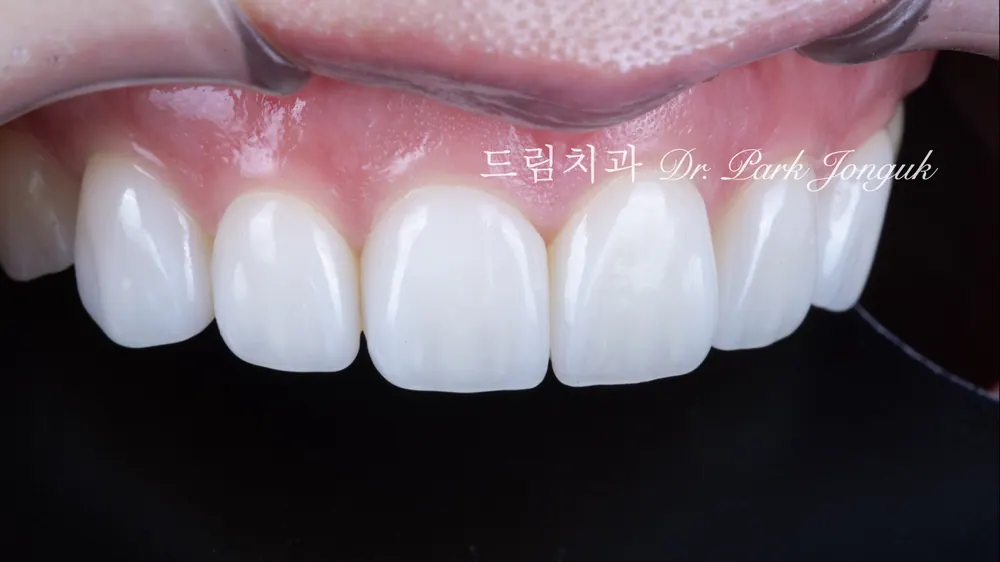 A no-prep veneer that stands out for its varied color and translucency