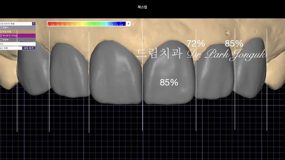 디지털을 이용한 정밀한 라미네이트 진단과정