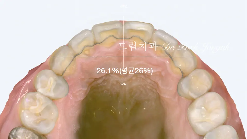 라미네이트 잘 하는 치과 고르는 법 — 진단부터 보증까지 6가지 기준 본문 사진 7