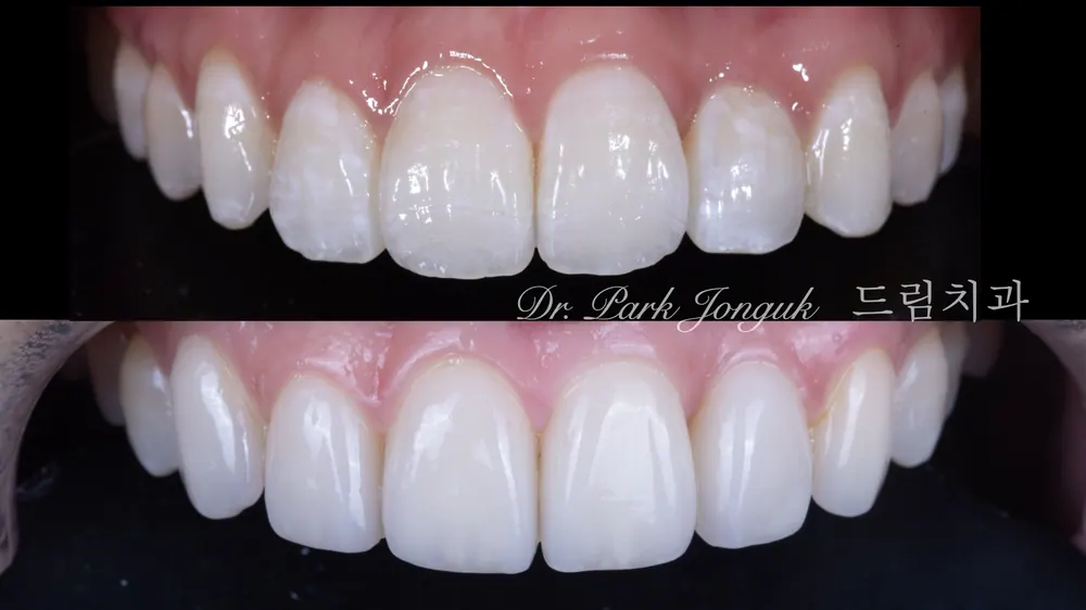 Lượng mài răng khi làm Veneer thay đổi tùy theo màu sắc, hình dáng răng và các yếu tố khác.