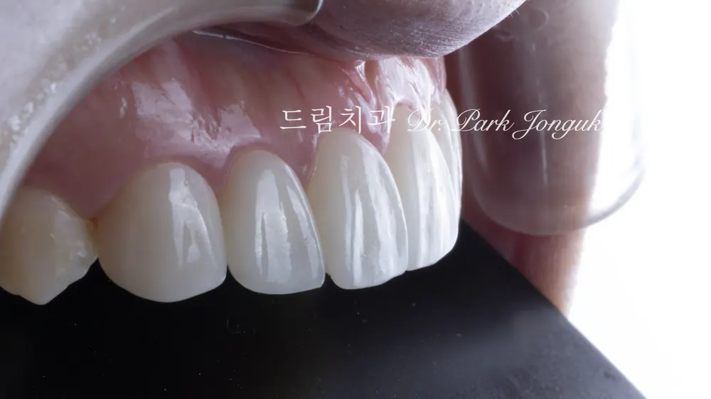 Ca Veneer không mài răng được hoàn thiện tự nhiên