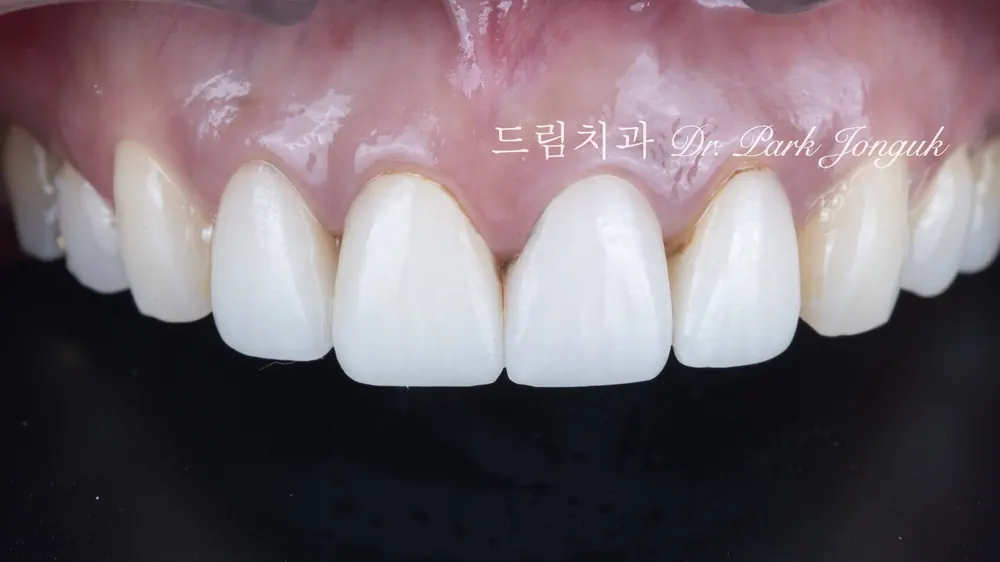 因瓷贴面周边变色而前来接受再治疗的病例