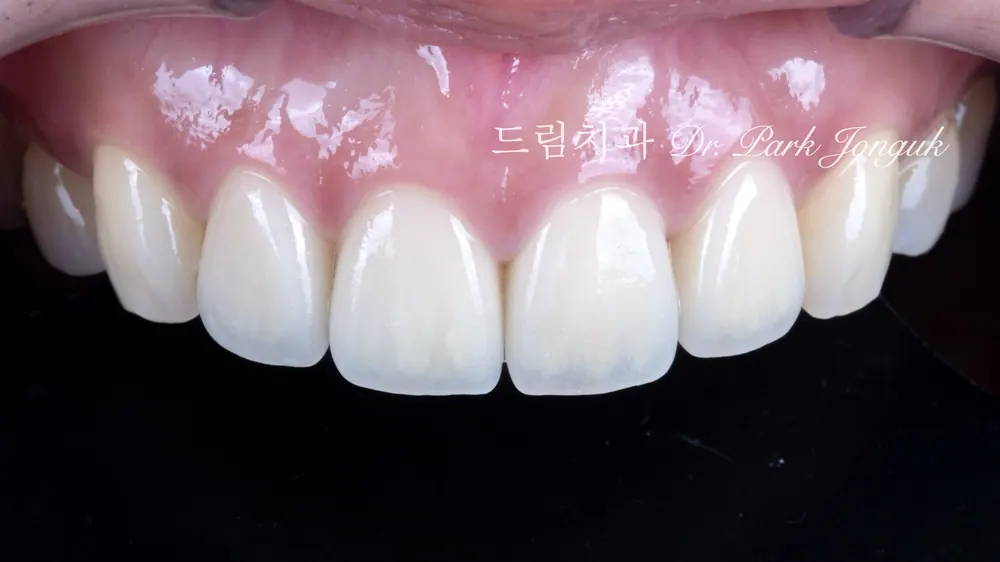 瓷贴面再治疗后的自然效果