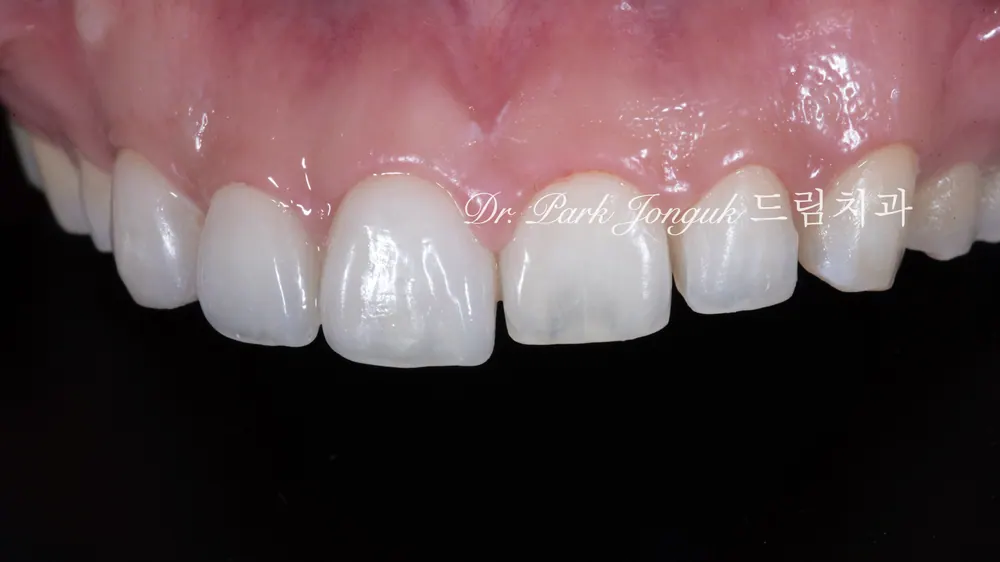 Trạng thái chỉ mới đặt Veneer lên một bên trong ca Veneer không mài răng
