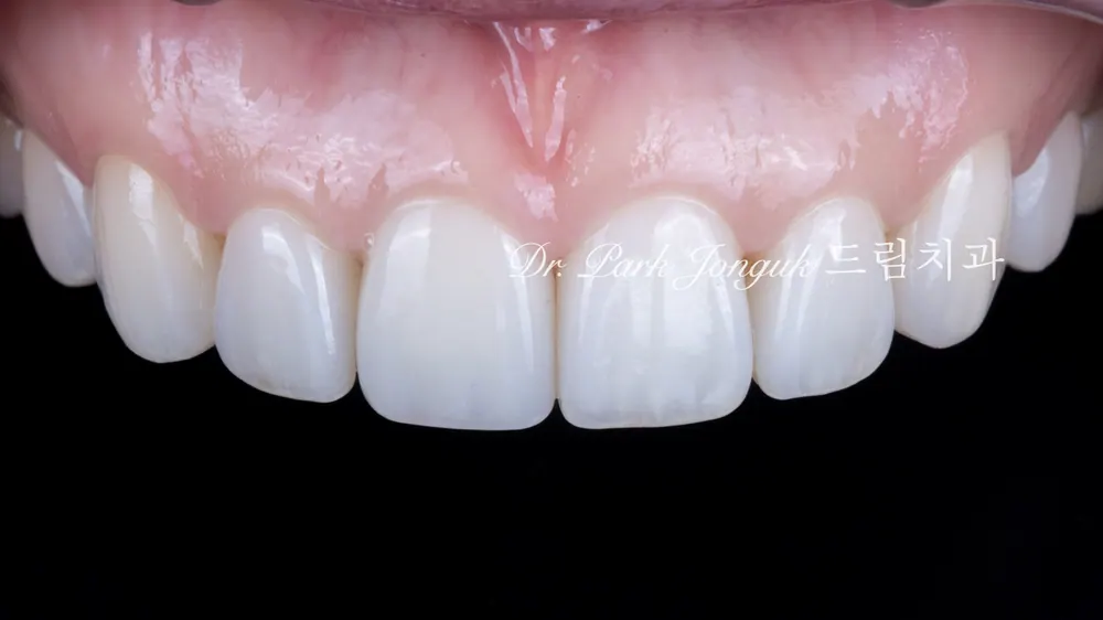 Băn khoăn về răng cửa: nên làm Veneer hay niềng răng trước? — ảnh 8