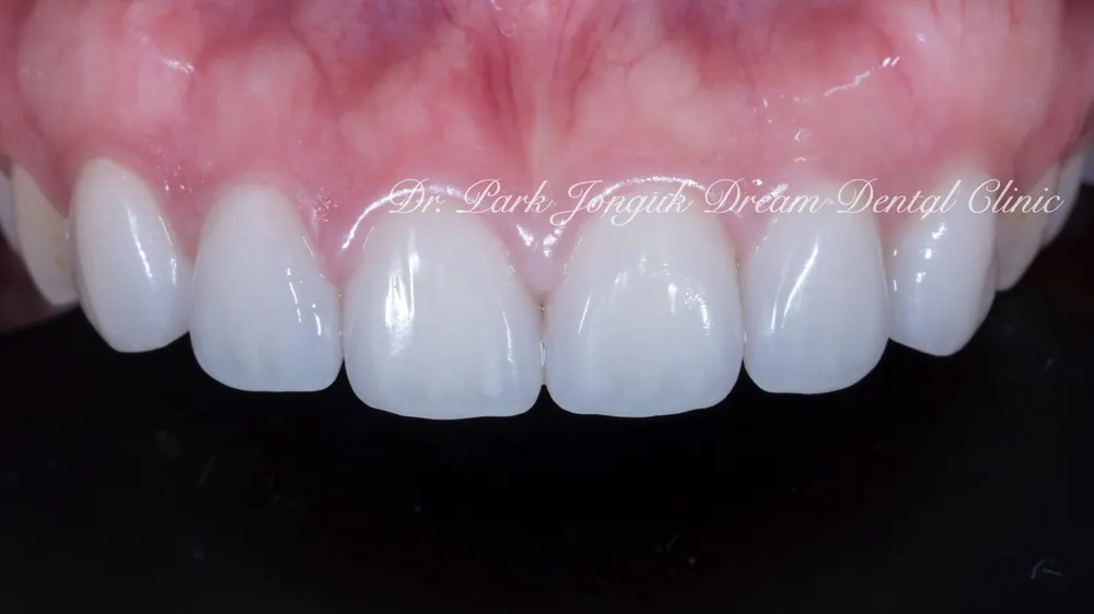 Veneer thể hiện độ trong suốt tự nhiên sống động ở rìa cắn