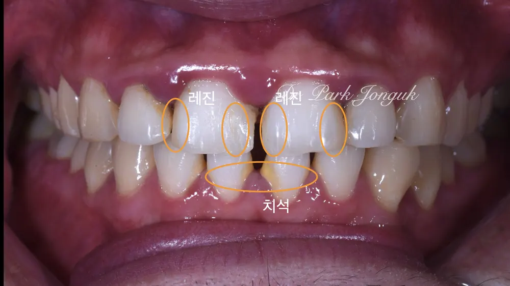Tình trạng bệnh nướu nghiêm trọng