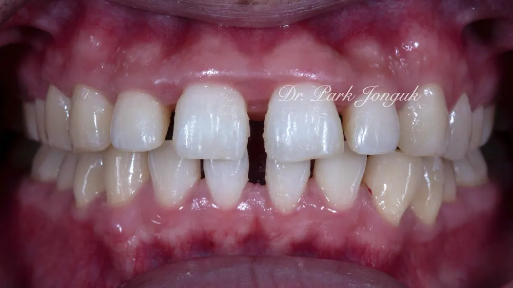 Tiến hành điều trị Veneer khi tình trạng bệnh nướu đã giảm đáng kể