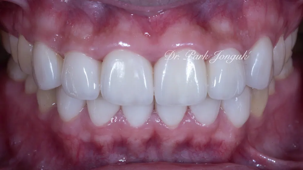 Hình ảnh sau khi điều trị dứt điểm bệnh nướu và hoàn tất Veneer