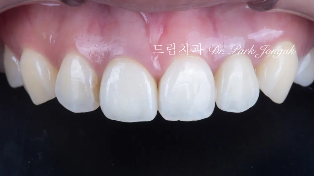 Trường hợp tìm lại được màu sắc ổn định nhờ răng toàn sứ