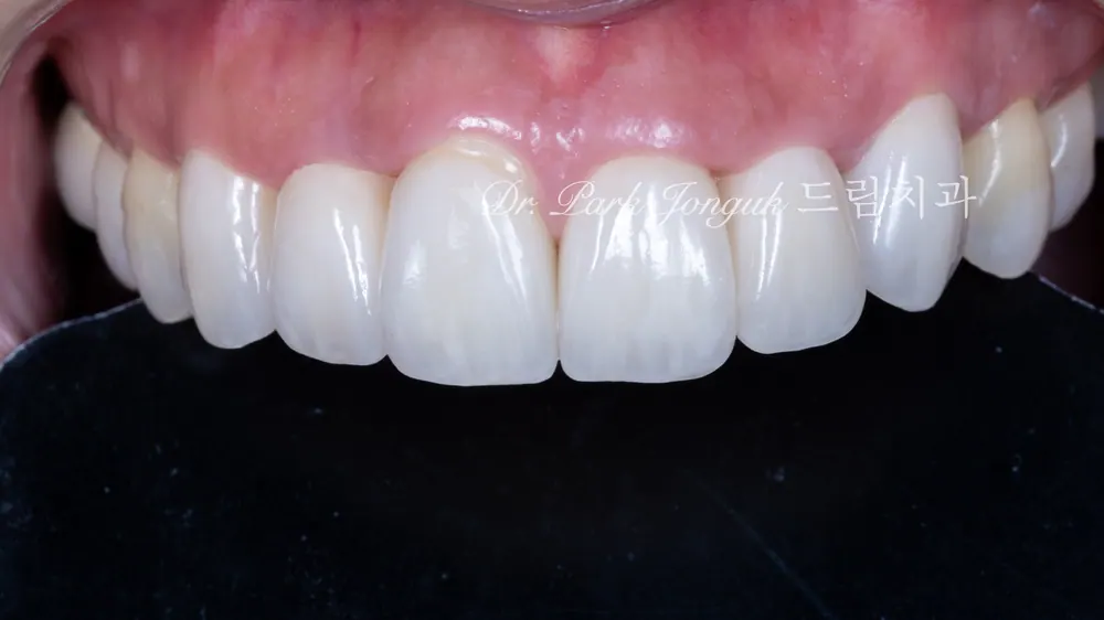 Sau khi làm lại, góc độ và hình dạng răng đã được chỉnh sửa lại.