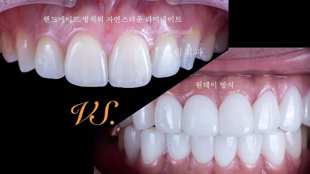자연스럽고 아름다운 라미네이트는 하루만에 만들 수 없습니다.