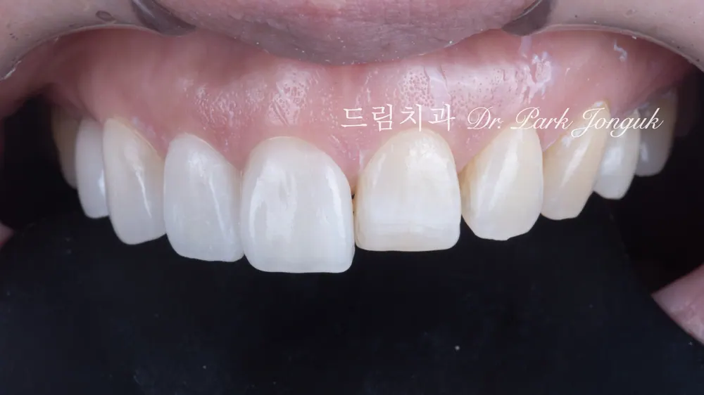 무삭제 라미네이트는 삭제가 없어서 부작용도 거의 없습니다.