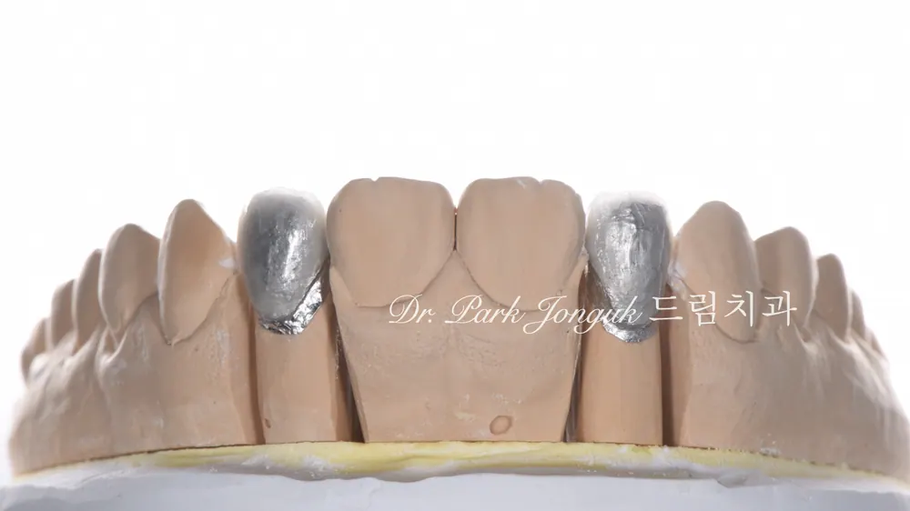 앞니 한 개만 라미네이트, 될까요? 사실 이게 제일 어렵습니다 본문 사진 7