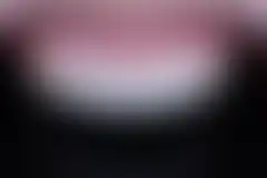 ทำวีเนียร์ใหม่ เคสที่ 4 — หลังการรักษา (เบลอไว้ — ดูได้หลังเข้าสู่ระบบ)